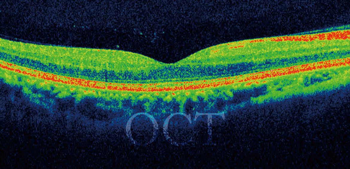 Ocular Choerence Tomographer