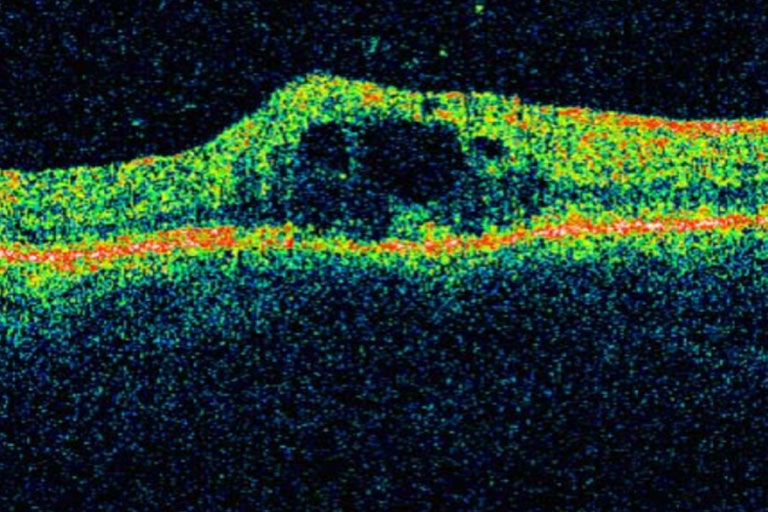 Ocular Coherence Tomographer