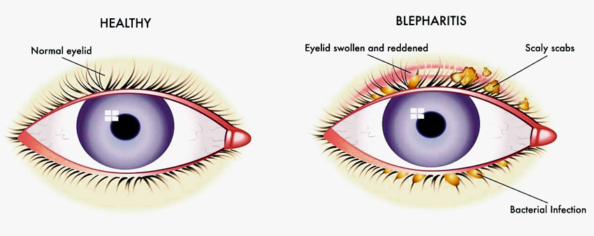 Blepharitis