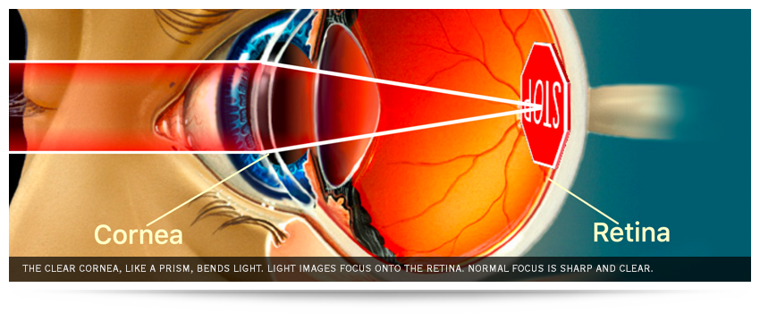 The clear cornea, like a prism, bends light. Light images focus onto the retina. Normal focus is sharp and clear.